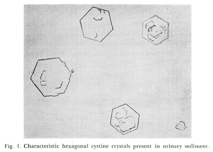Calculi de cistină