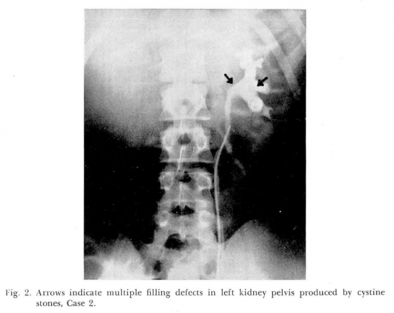 Calculi în pelvisul renal stâng