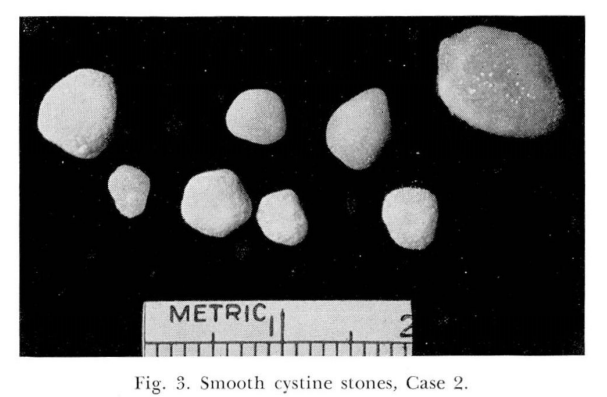 Calculi de cistină