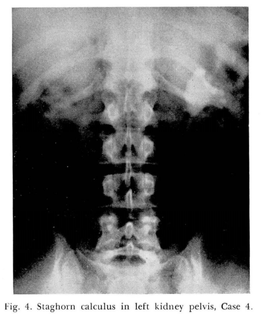 Calcul ramificat în bazinetul renal stâng